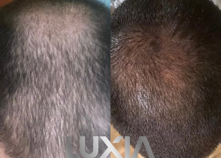 LUXIA Exomes Hair+ 1 x 5ml